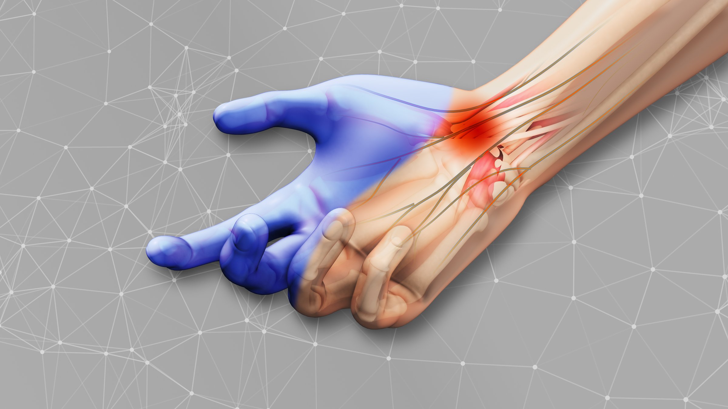Carpal tunnel wrist illustration