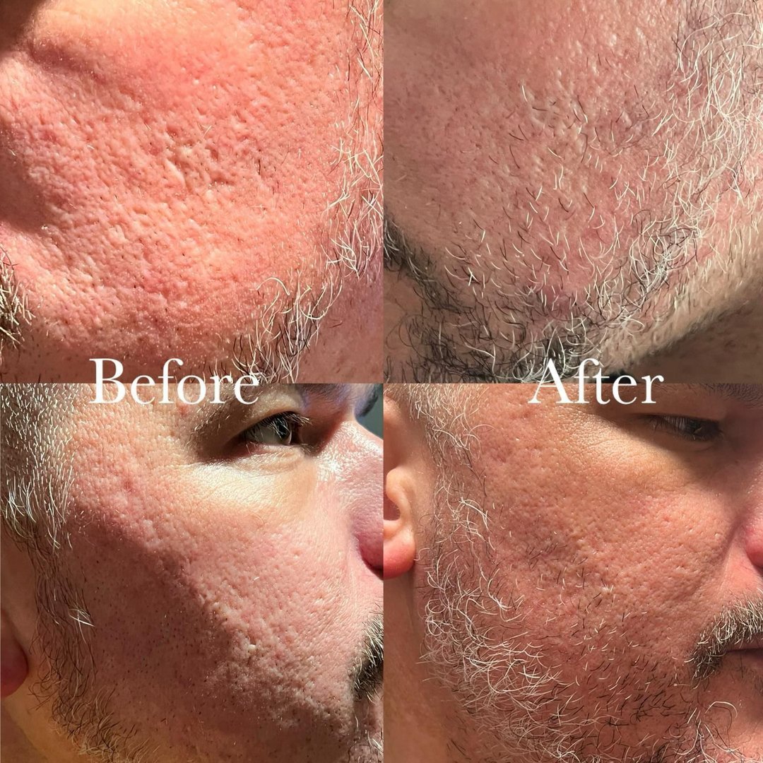 Acne scar before and after treatment