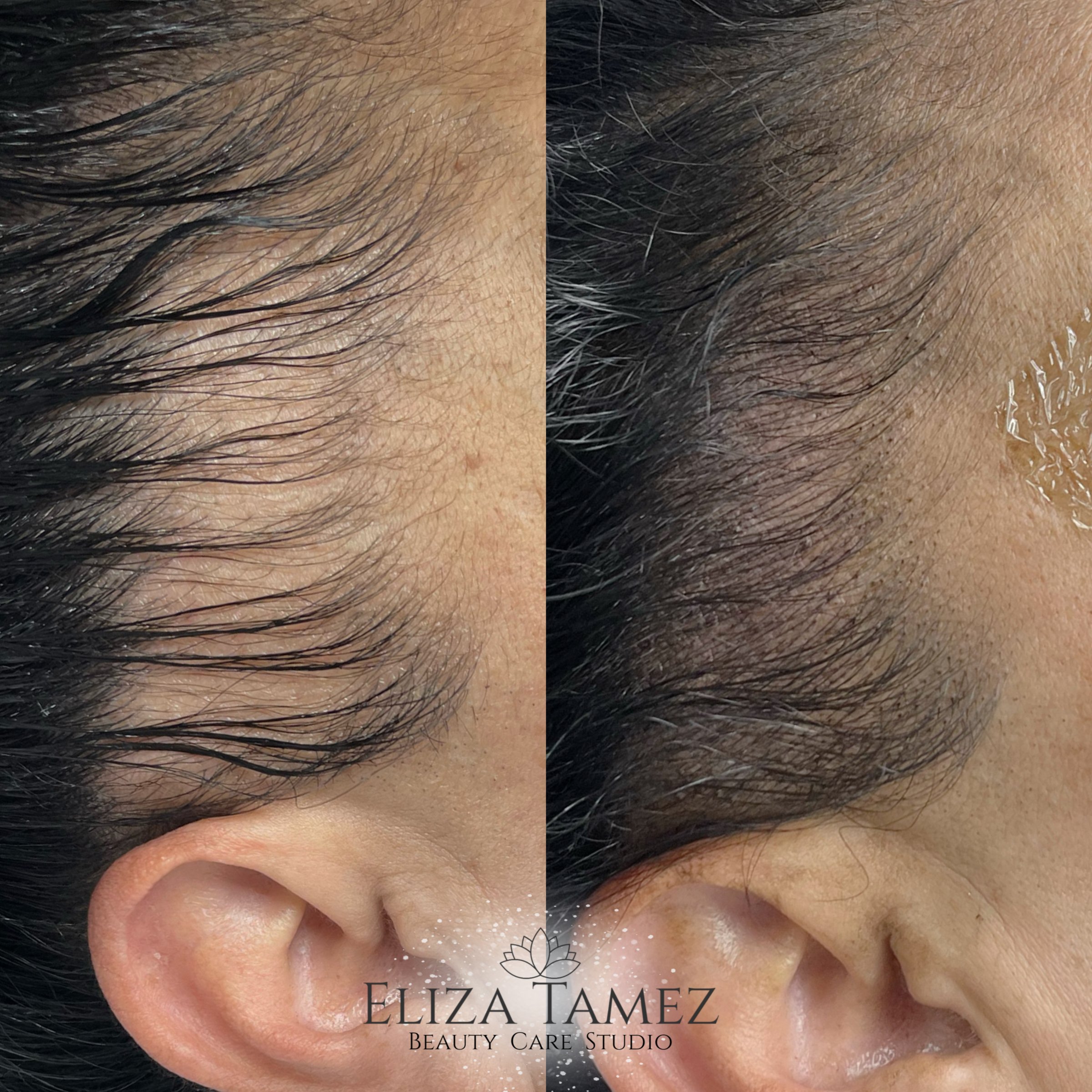 Micropigmentación capilar scalp