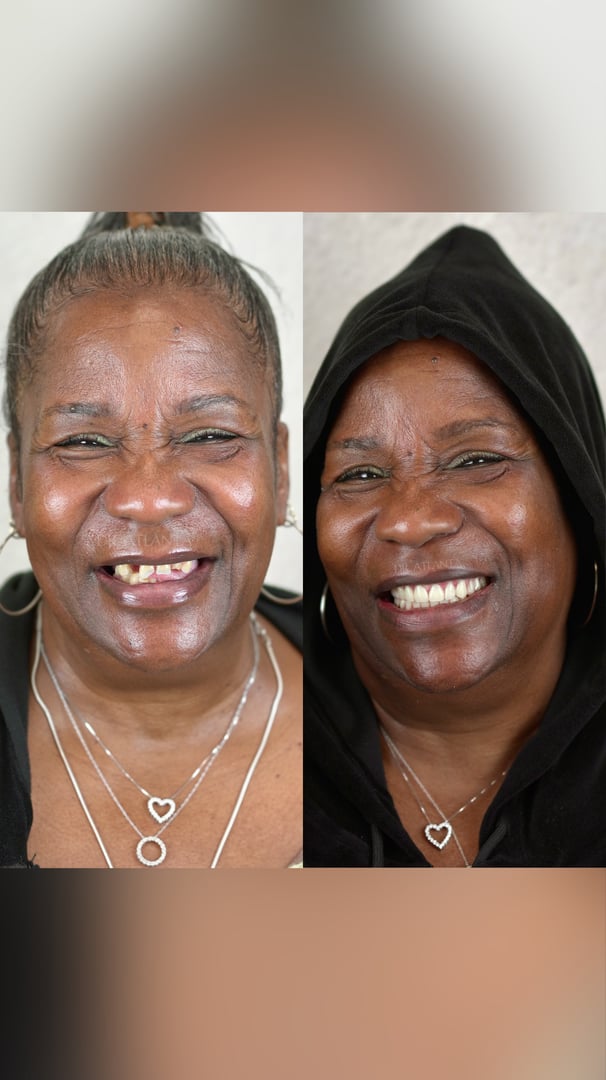 Full Smile Makeover