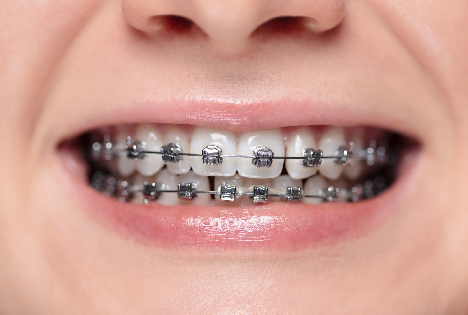 Woman with braces on her teeth is smiling. Metal bracket system on the teeth of a young woman. Shallow depth of field