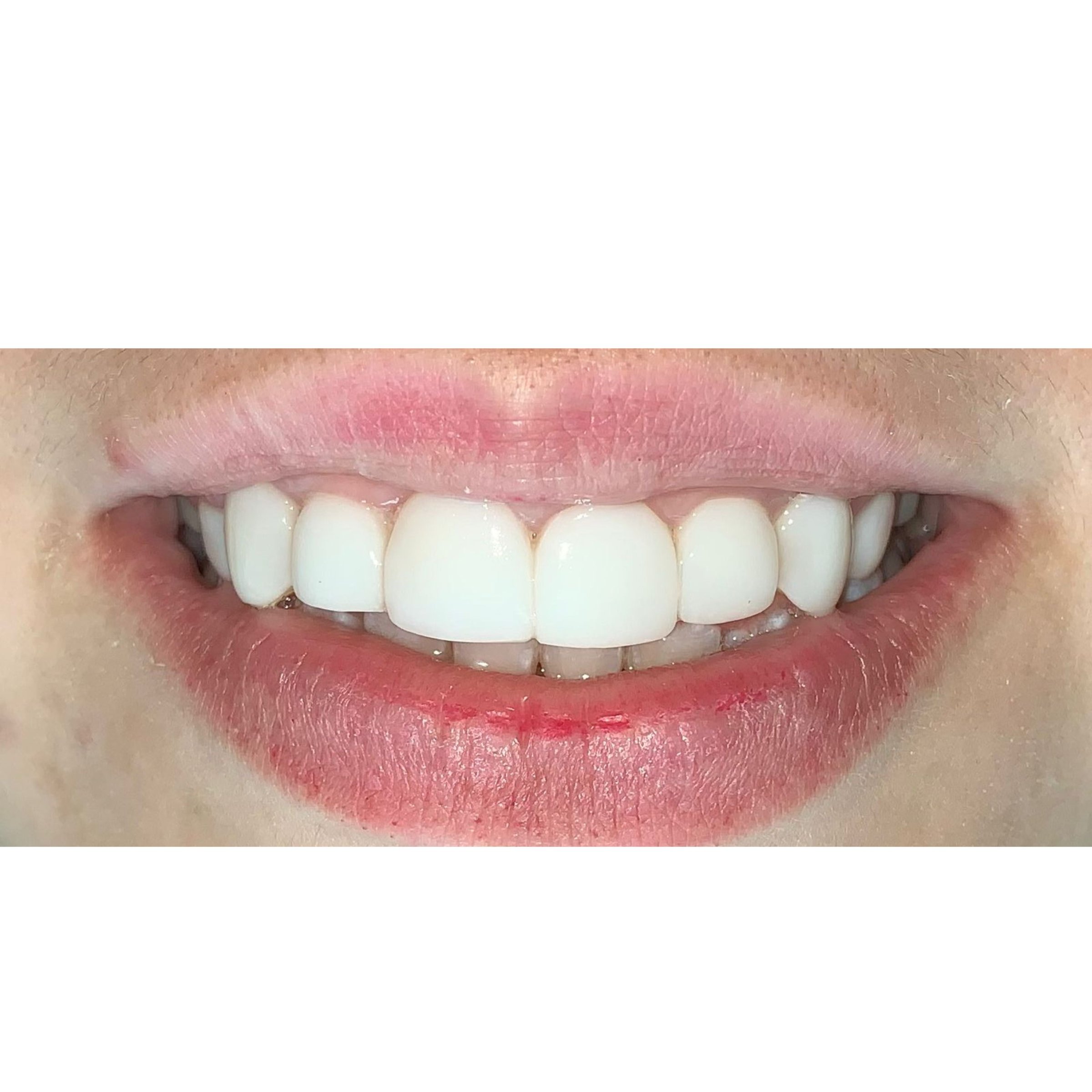 Sonrisa con carillas de resina