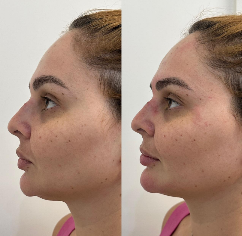 Harmonização Facial - Antes e Depois