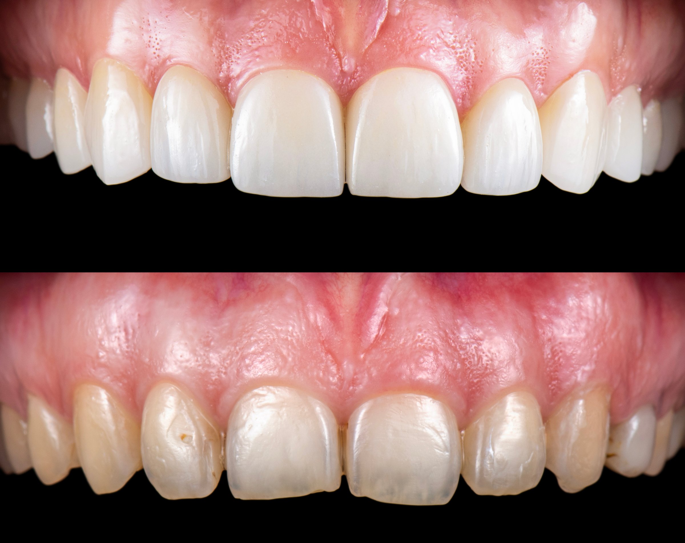 ceramic crowns and veneers before and after picture