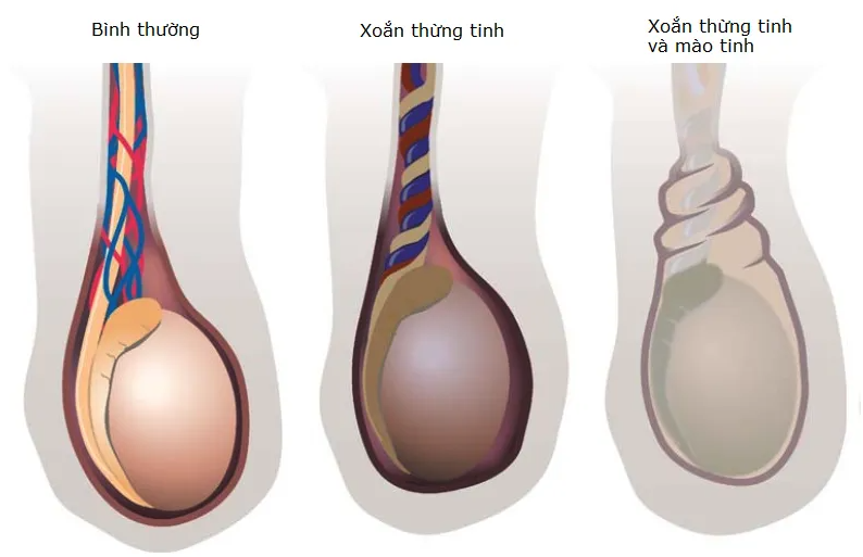 Nguyên nhân sưng tinh hoàn