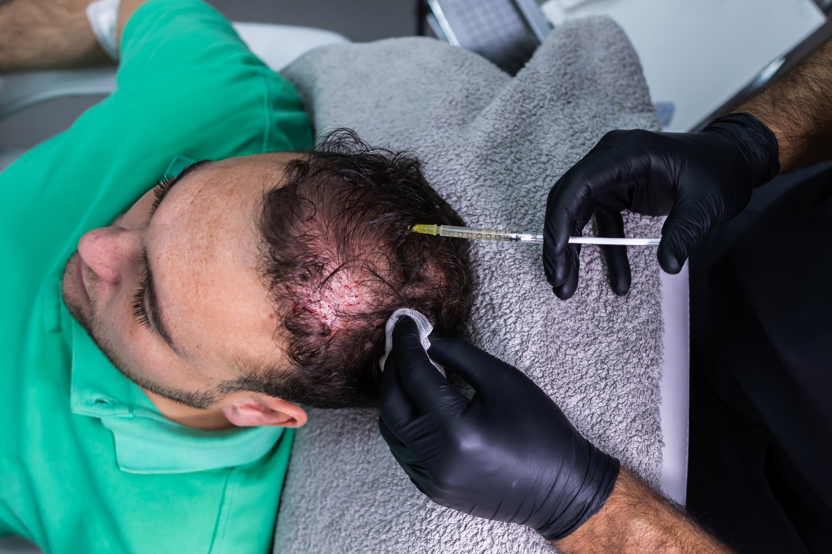 Treatment: Hair growth PRP therapy