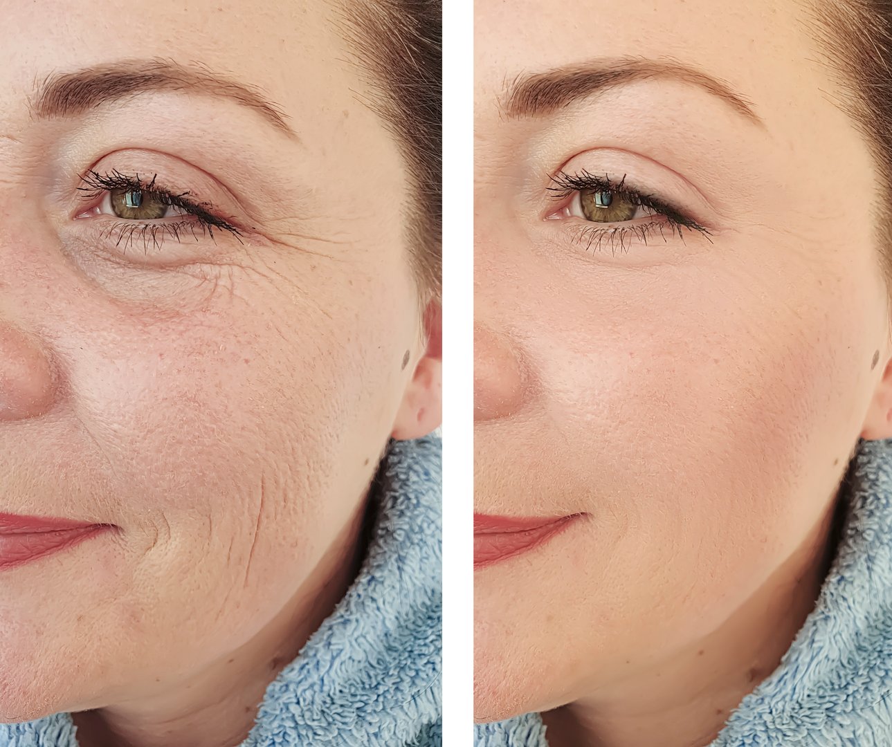 Elderly woman's wrinkles face before and after correction procedures