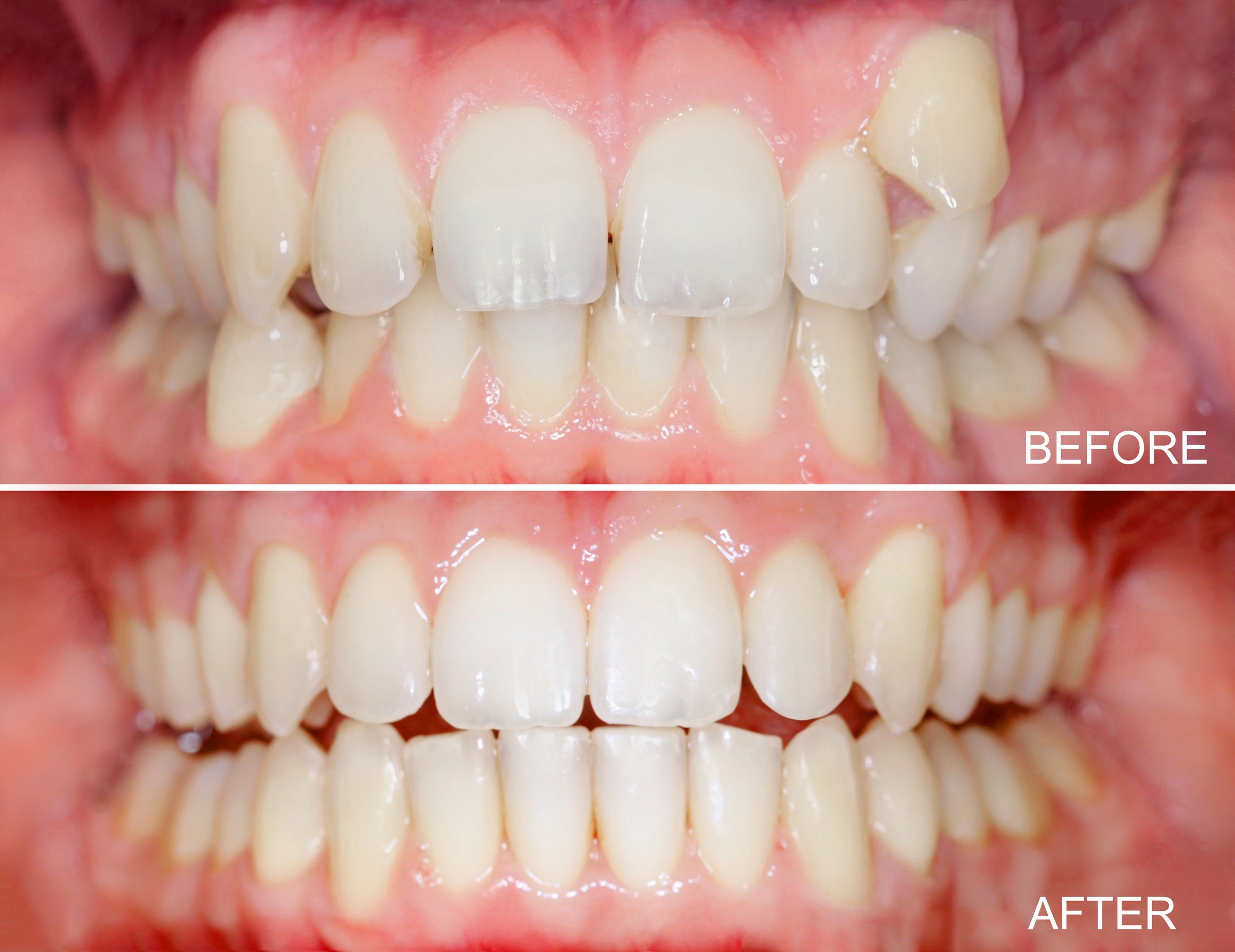 Comparison of before and after orthodontic treatment, illustrating crooked teeth transformation. aligners effectiveness.