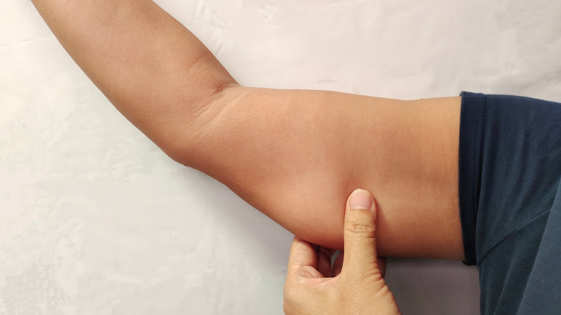 Antes de lipoabdominoplastia