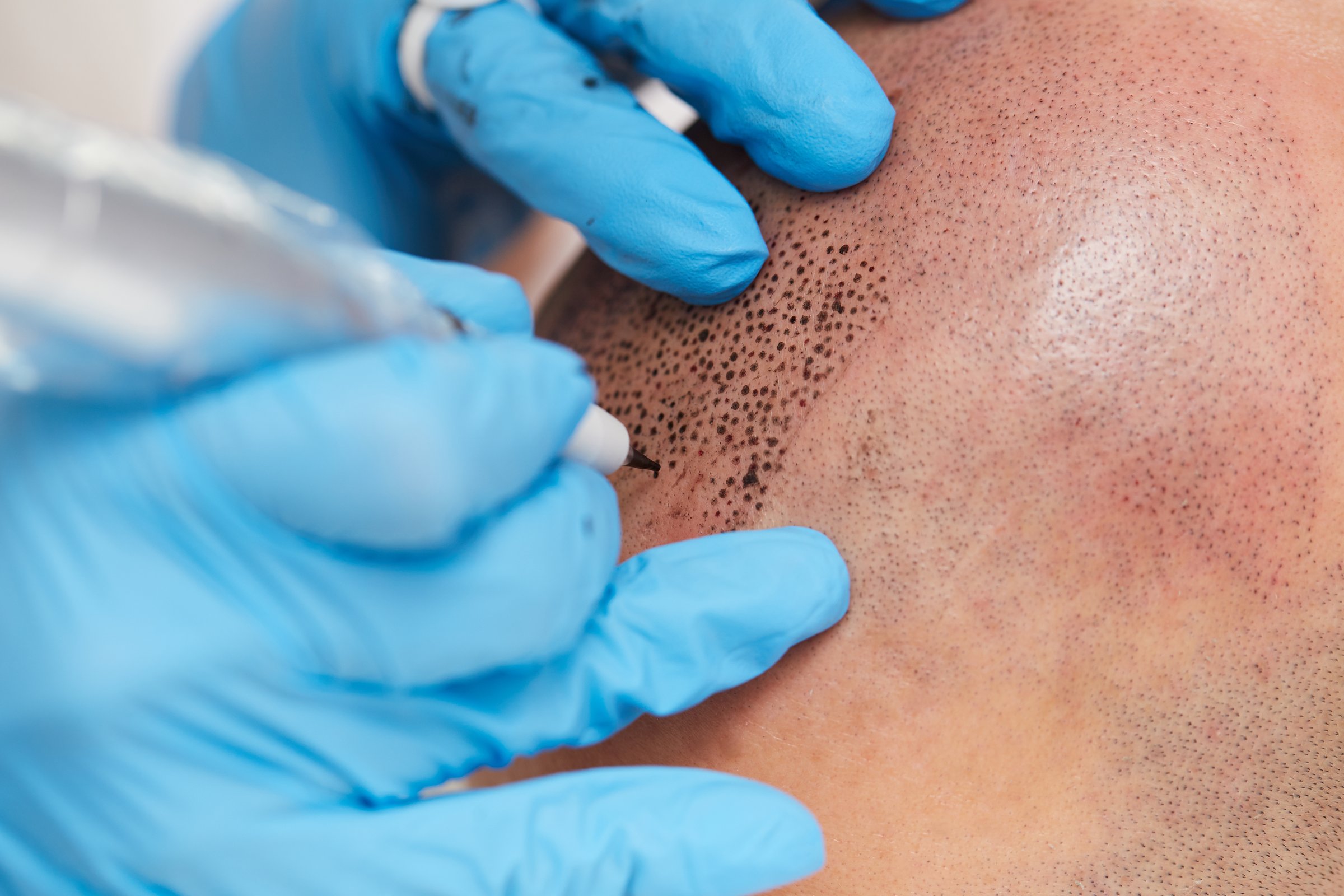 professional tattooist making permanent make up tricopigmentationprofessional tattooist making permanent make up tricopigmentation