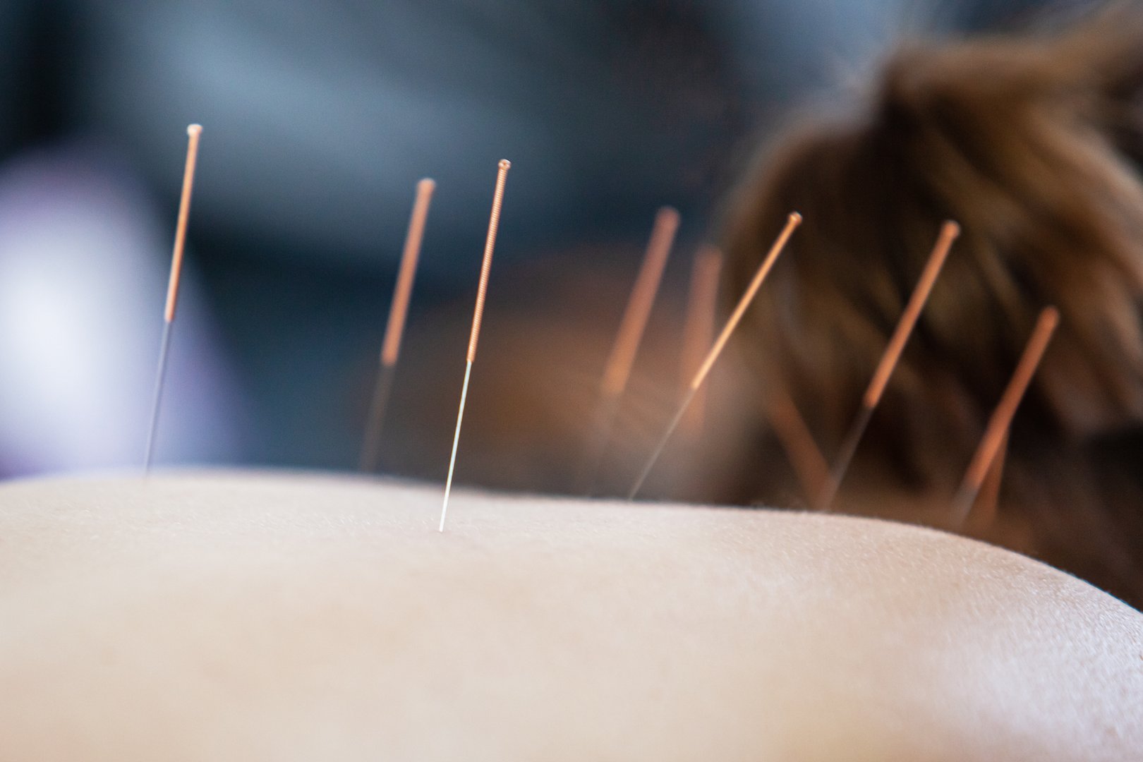 Chinese medicine. Close-up of a doctor's hands doing acupuncture.