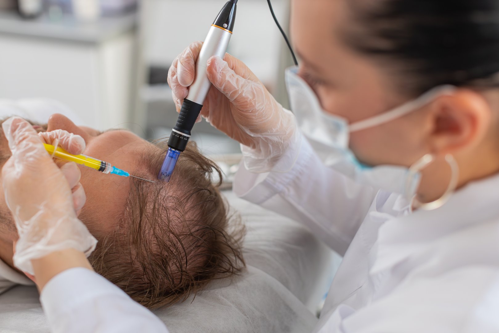 Alopecia. Man hair loss treatment regeneration. Trichologist cosmetologist doctor applies exosomes vitamin serum syringe injections on head scalp for dermapen fractional microneedle clinic mesotherapy