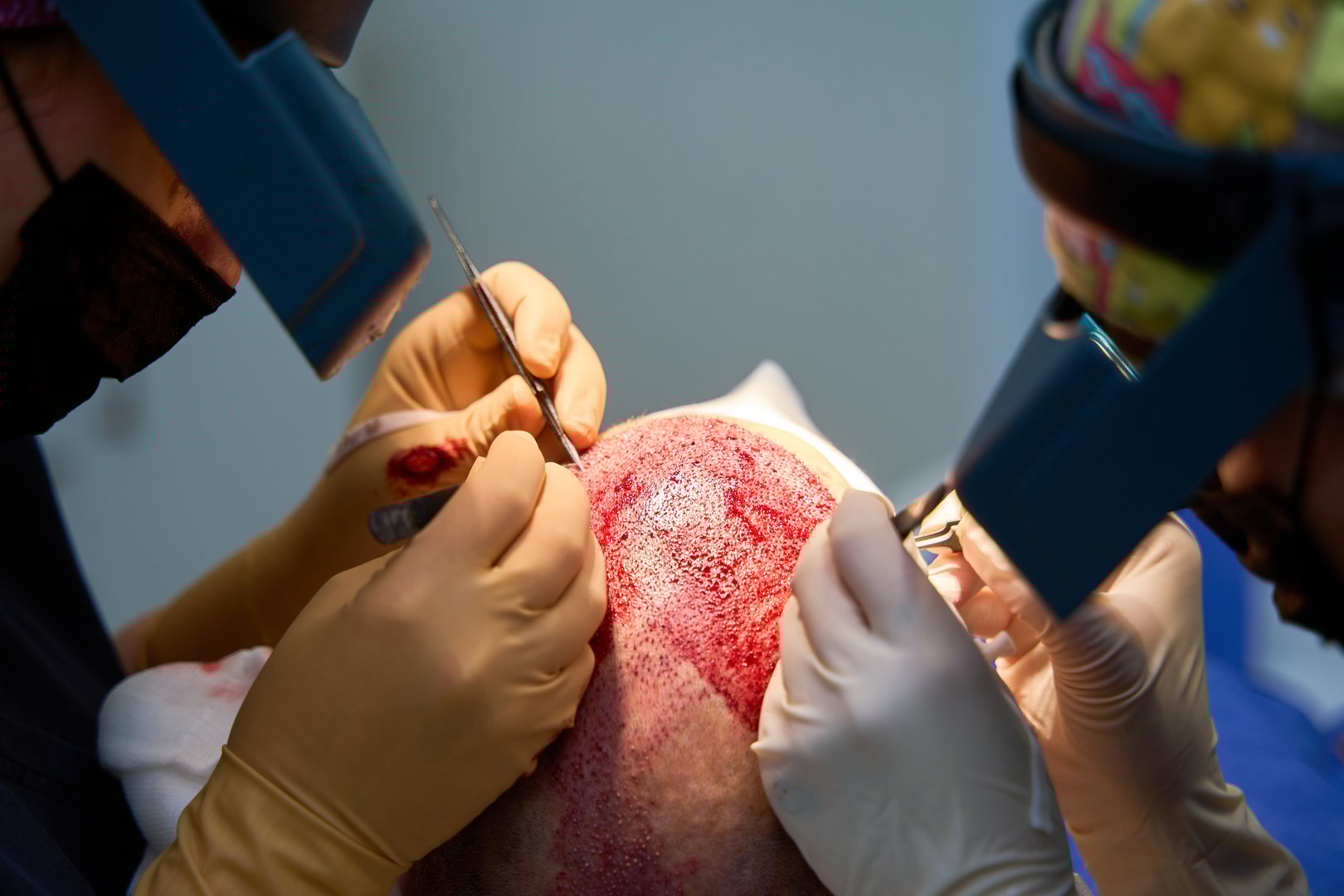 Surgeons performing hair transplant procedure with surgical tools
