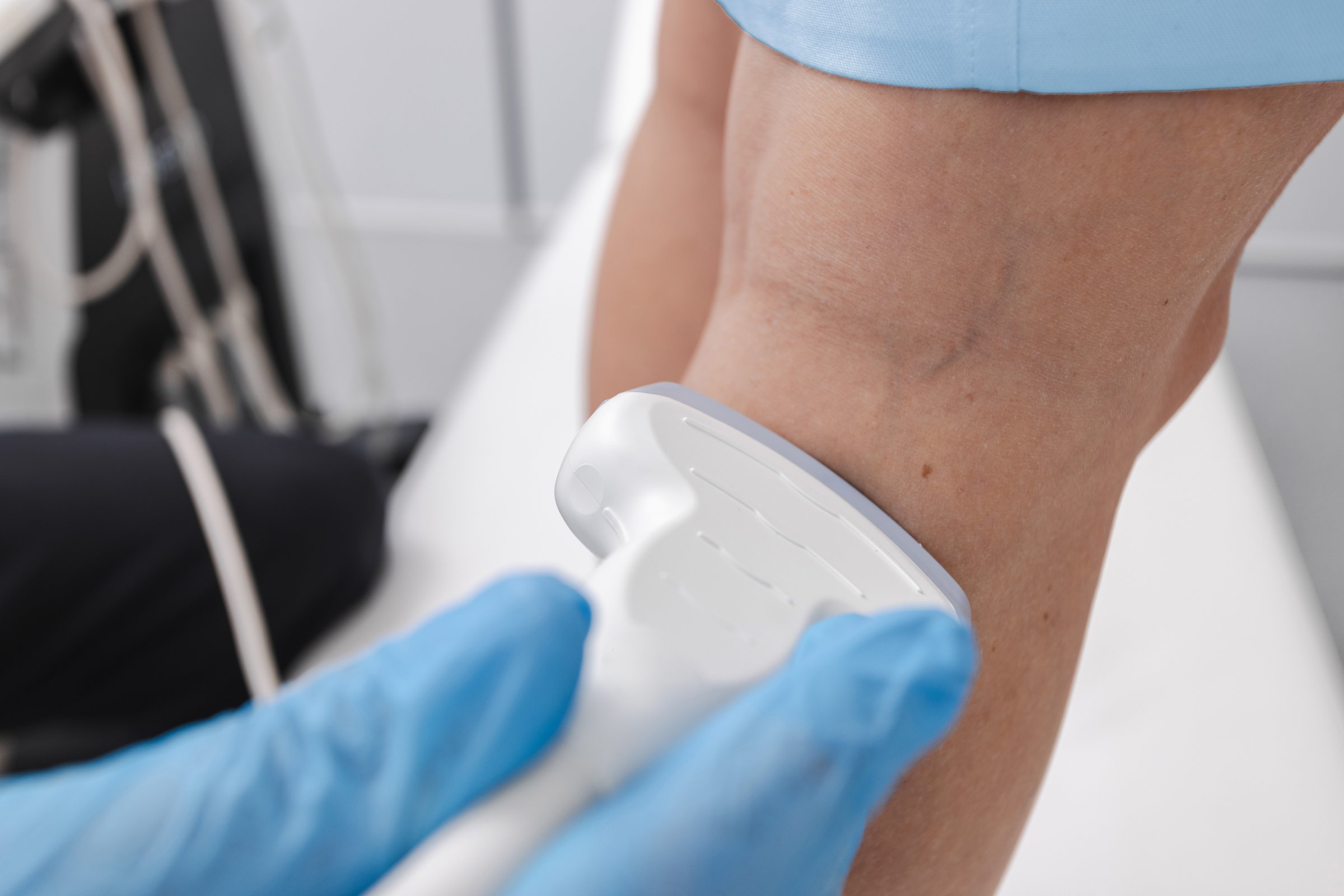 Ultrasound vascular diagnostics process of female patient's legs with varicose veins, close-up. Leg venous ultrasound