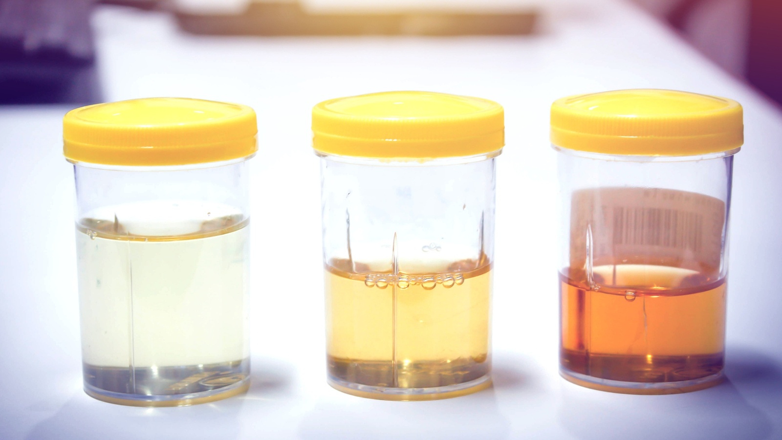 Triệu chứng tiểu ra mủ