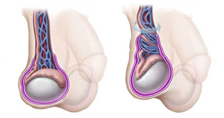 Sưng tinh hoàn là gì