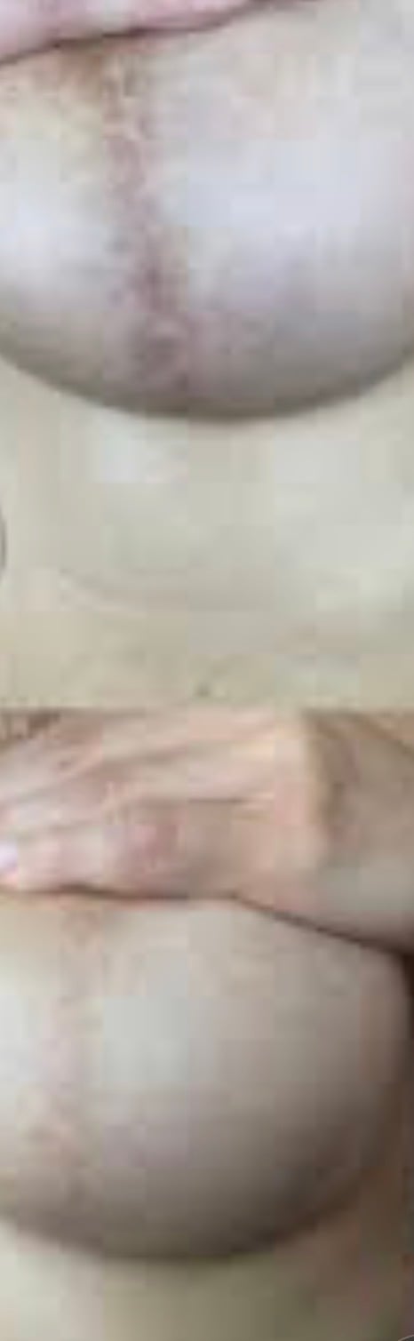 Before and after breast restoration scar camouflage result