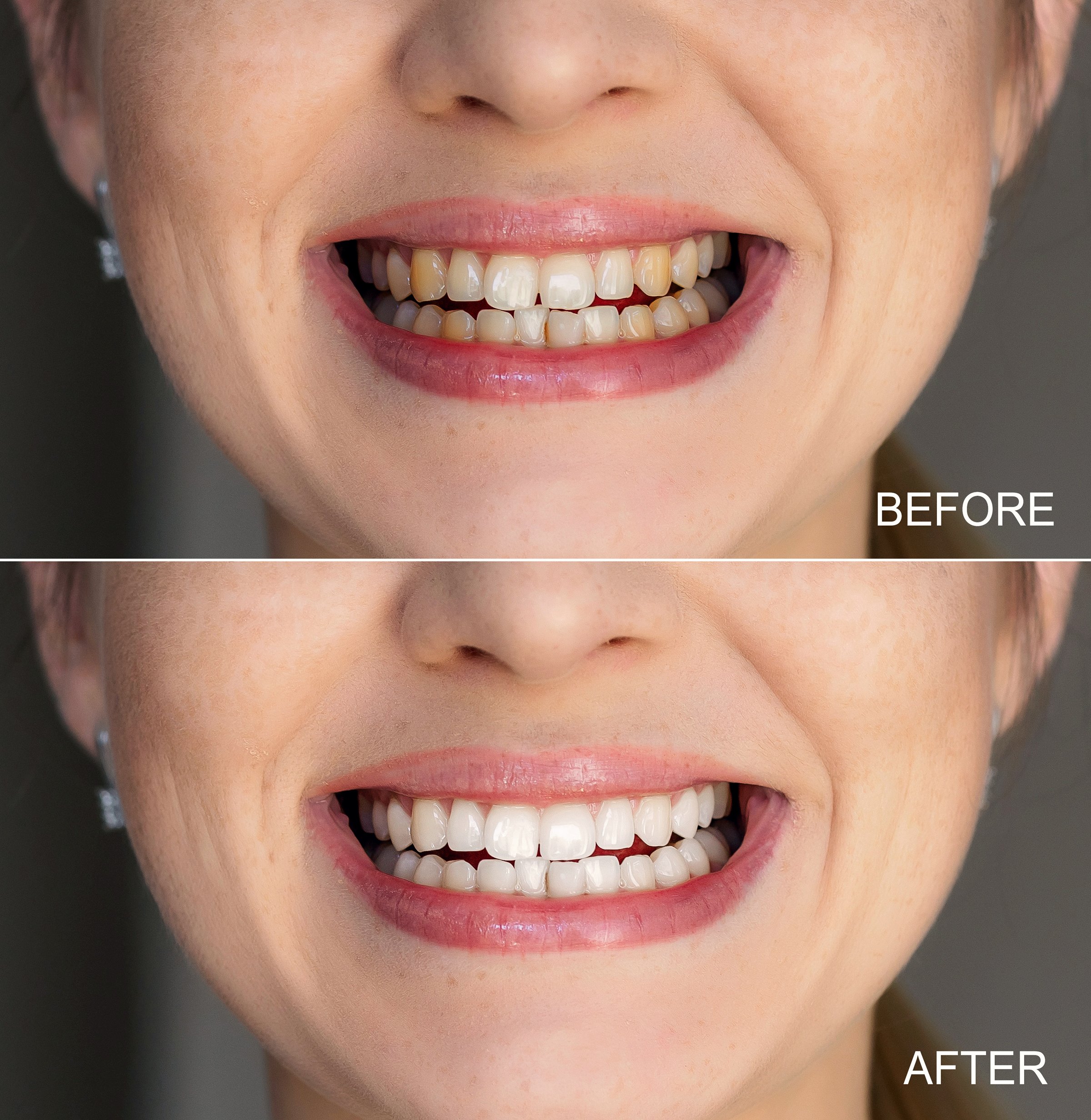 Side-by-side comparison image displaying teeth whitening improvement before and after treatment.
