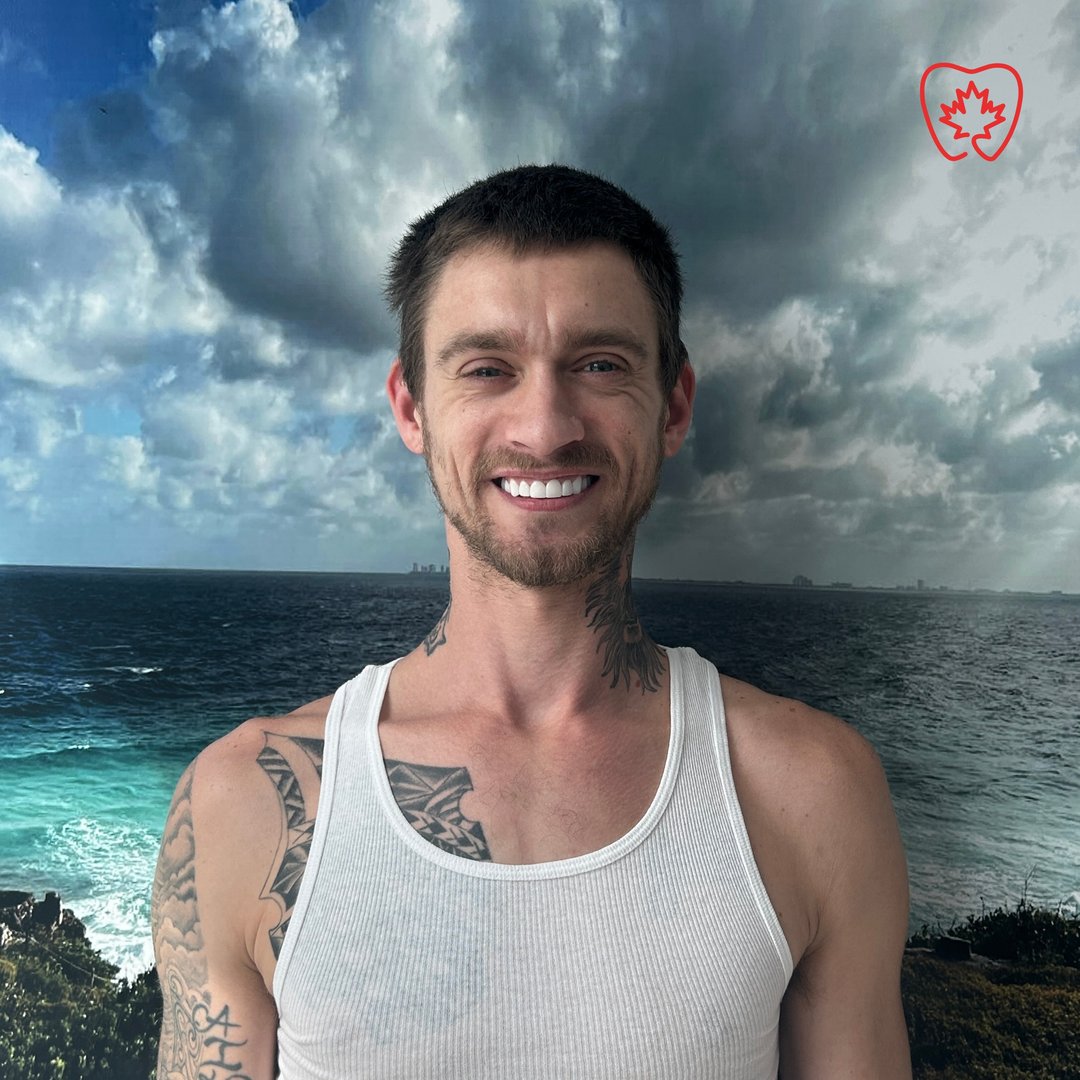 Carillas dentales - Sonrisa transformada