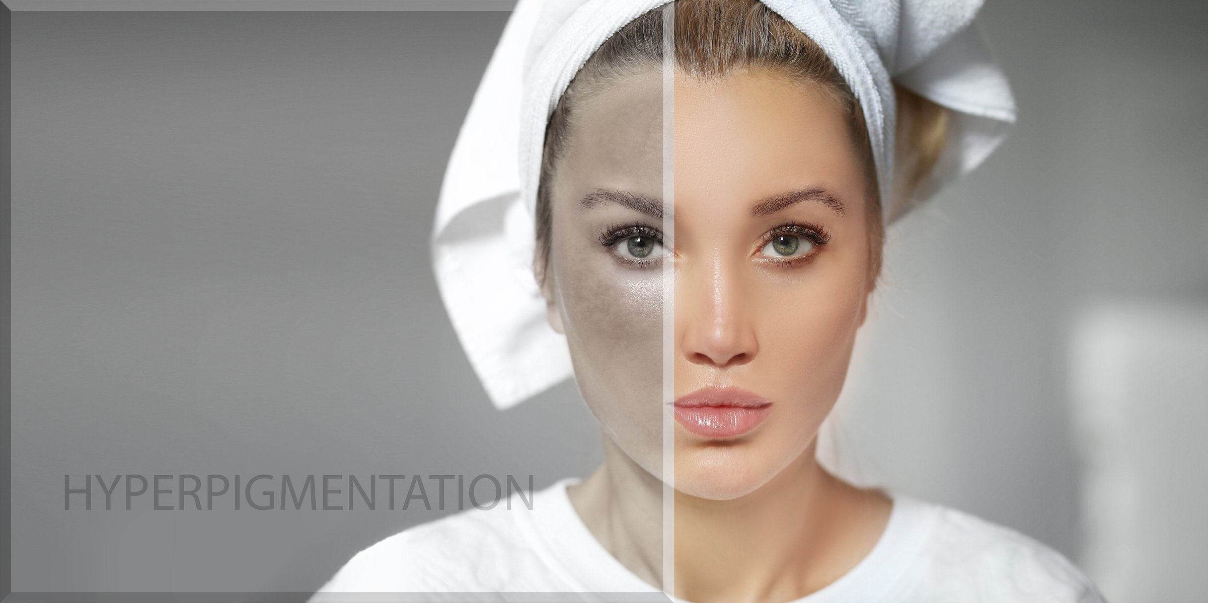 Dark spots, freckles,hyperpigmentation(melasma or chloasma),concept - skin lightening, skin whitening, fruit acids,AHA, Skin Brightening