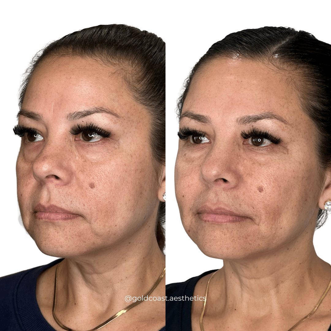 Complete facial balancing before and after