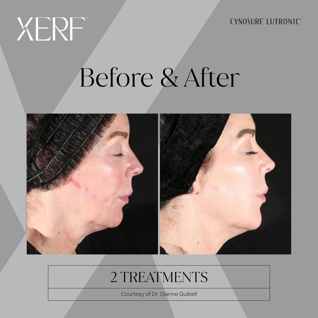 Xerf treatment before and after results