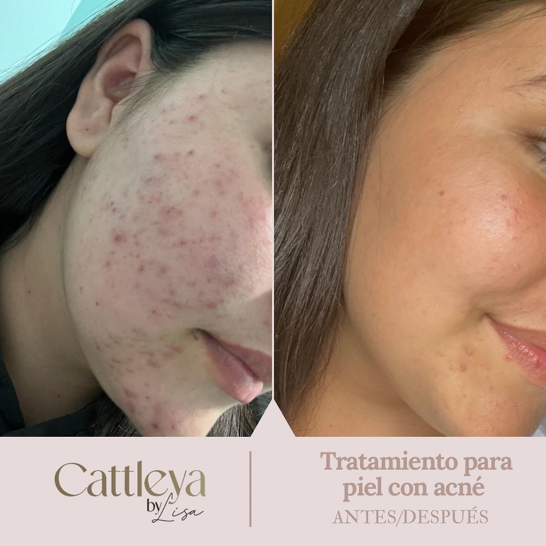 Transformación facial - Tratamiento especializado