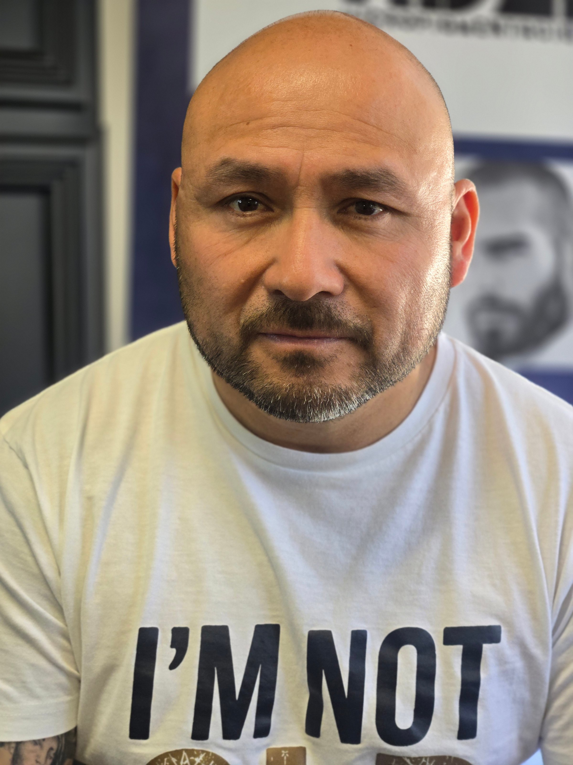 Before and After Scalp Micropigmentation Results - Real Client Transformation