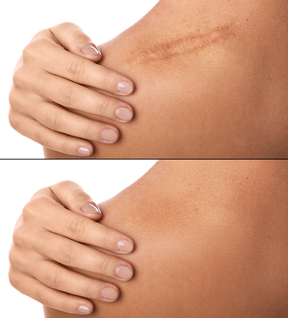 Comparison of female shoulder after scar removing procedure