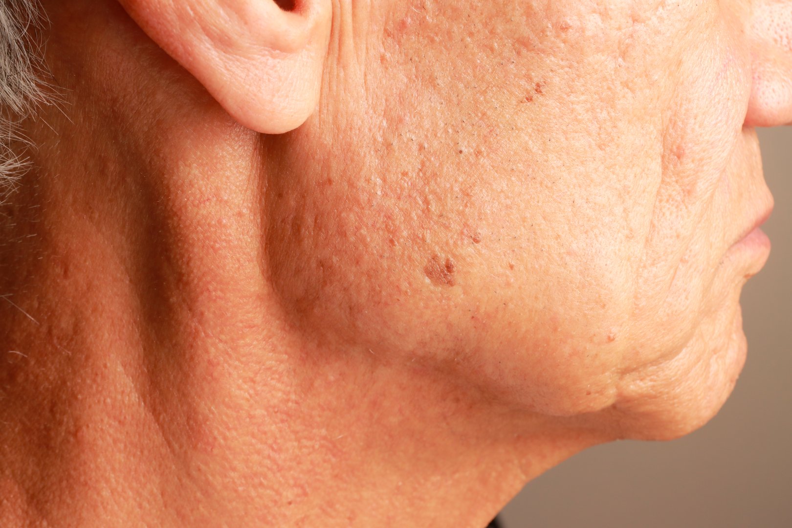 Mature man with age spots or liver spots on the side of his face likely cause from sun exposure