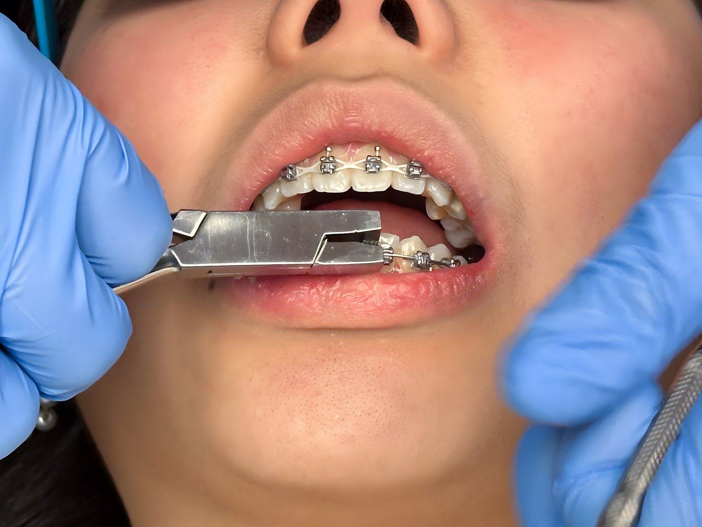 Dentist is installing braces on a teenage girl at the orthodontist clinic.