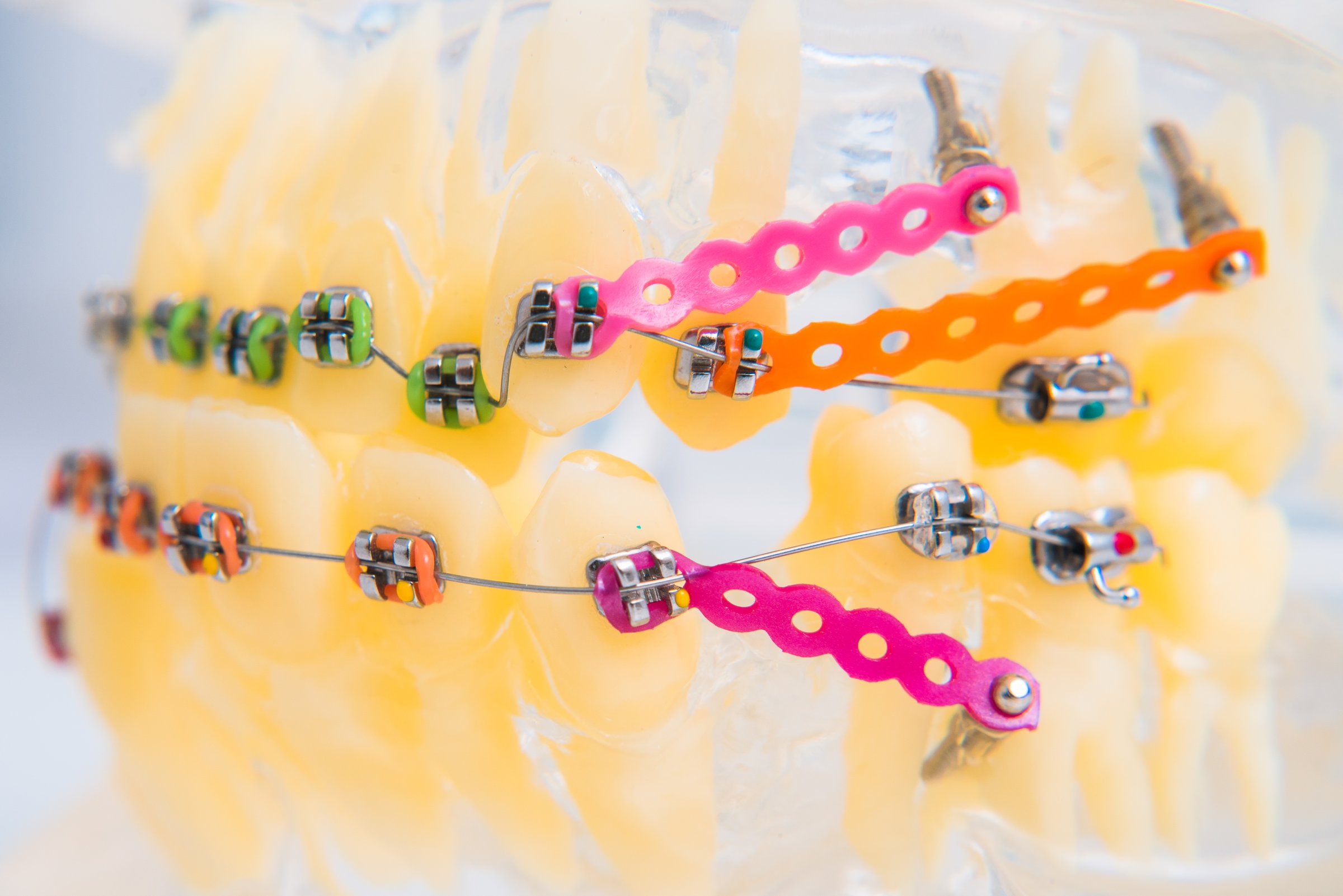 macro photography shows how the braces are arranged