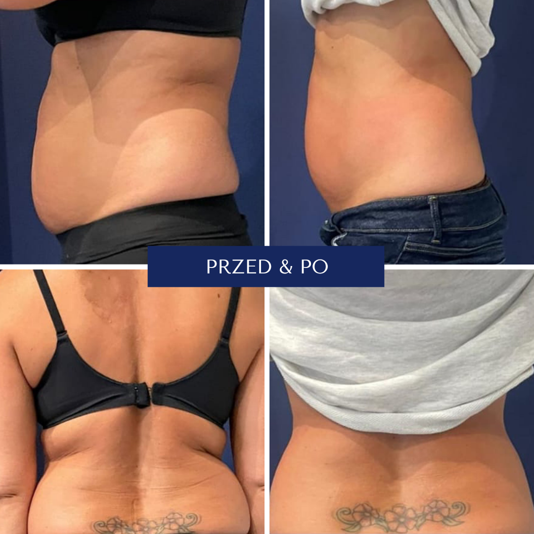 Magnifico efekty przed i po zabiegu 3