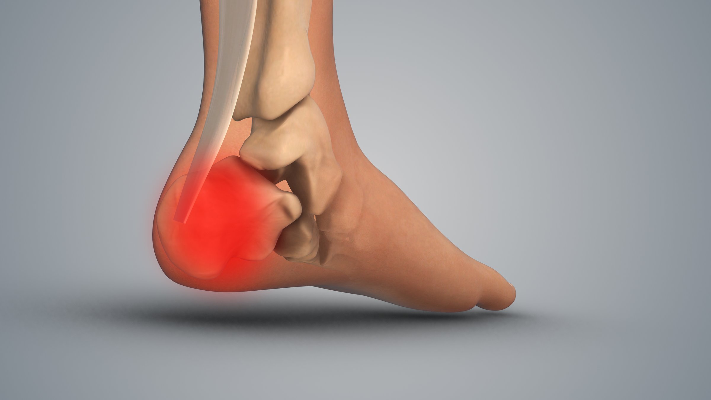 This stock image showcases a painful inflammation in the heel, focusing on the anatomy of the foot and the discomfort caused by such conditions. It captures a close-up view of a heel being examined, highlighting the ligaments, tendons, and joints affected by injury or strain. The visual includes a therapist or chiropodist providing care, emphasizing the importance of massage, stretching, and therapy for relief and recovery.