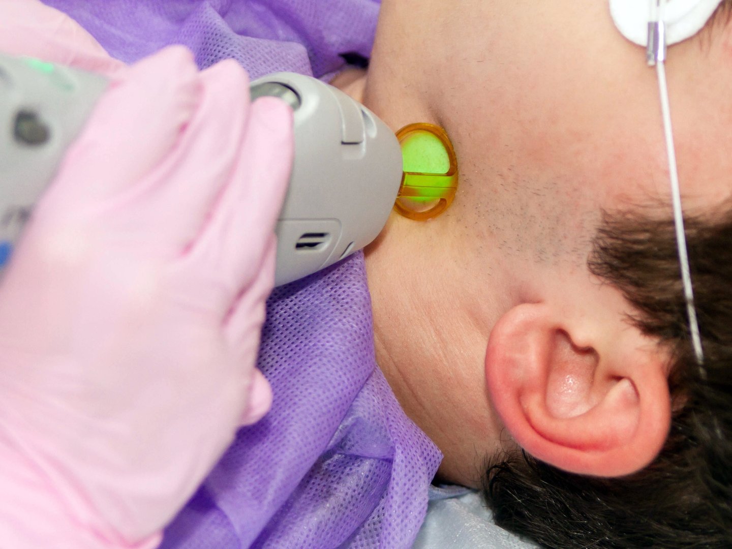 A medical specialist performs a laser hair removal procedure on a young man's temporal region, lying on a couch