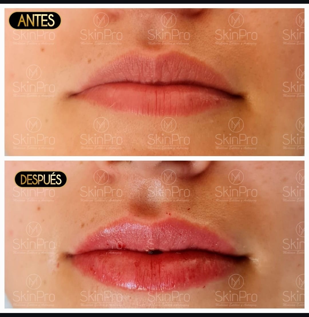 Resultado del tratamiento