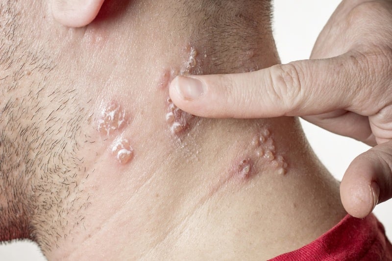 Hình ảnh minh họa bệnh lậu