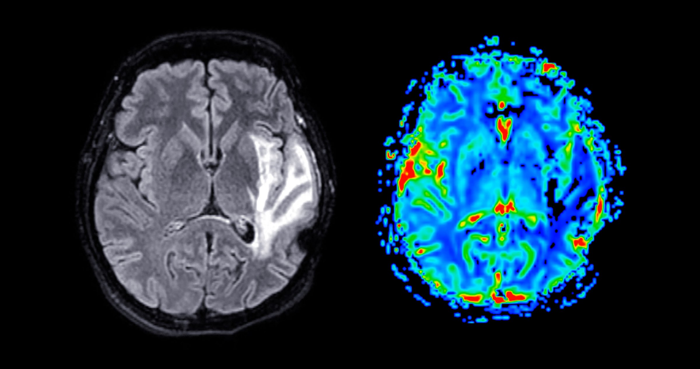 MRI brain perfusion imaging helps assess cerebral blood flow and tissue viability. It aids in diagnosing strokes, tumors, and other neurological conditions.