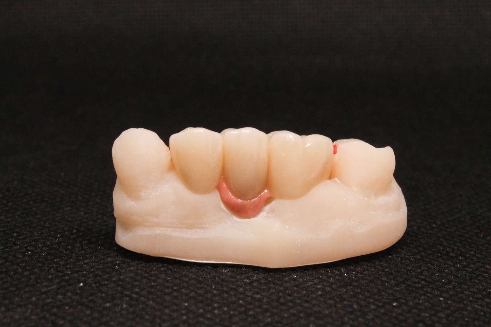 Puente sobre implante dental