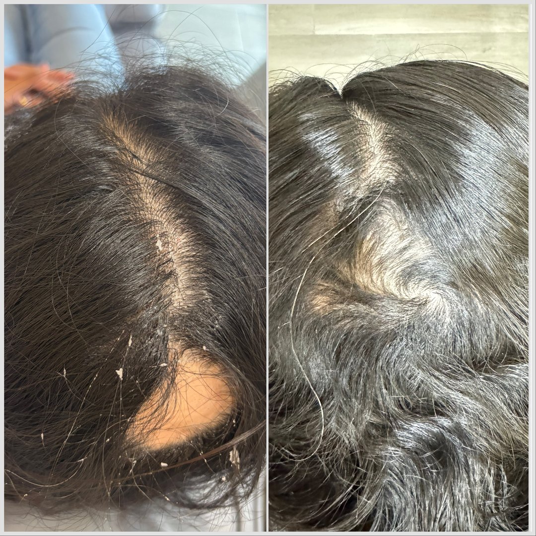 Antes y después - Caída de cabello