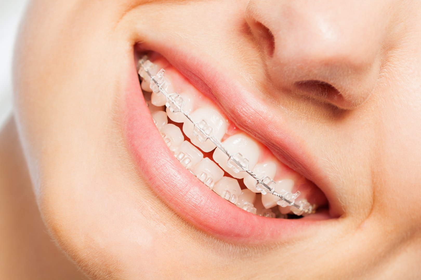 Happy smile of young woman with clear dental braces