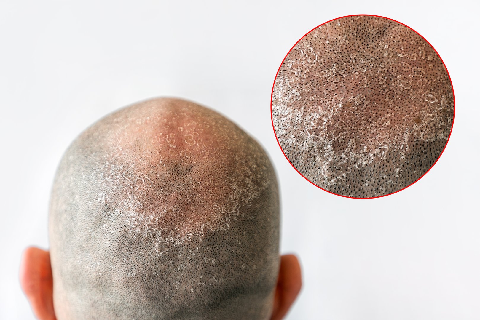 Man's bald flaky head with dandruff close-up, back view. White background with zoomed circle of skin problem. The concept of psoriasis and alopecia.
