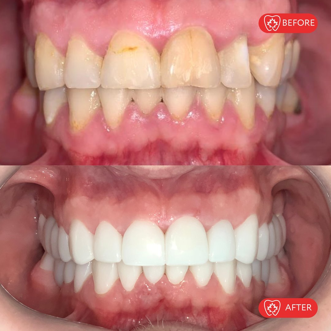 Carillas dentales - Antes y después