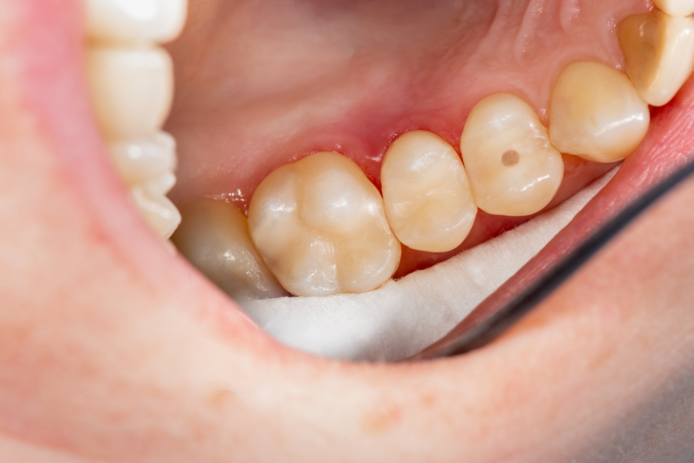 what are tooth coloured fillings and how long do they last