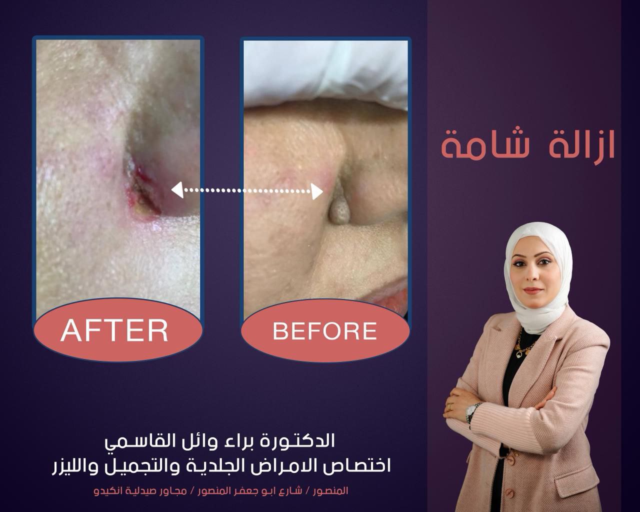 Before and after acne treatment results