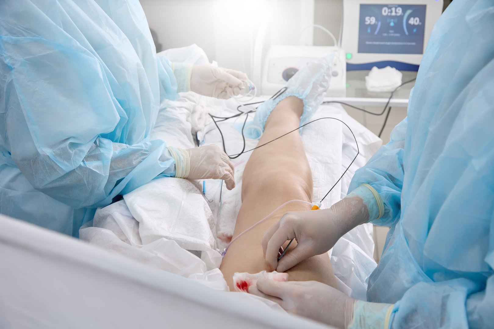 Surgeon in medical gown in operating room inserts a catheter into vein on patient's lower limb to treat varicose veins. Surgical treatment of varicose veins in hospital by a team of vascular surgeons