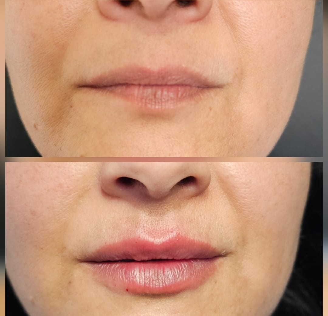 Resultado del tratamiento - Transformation