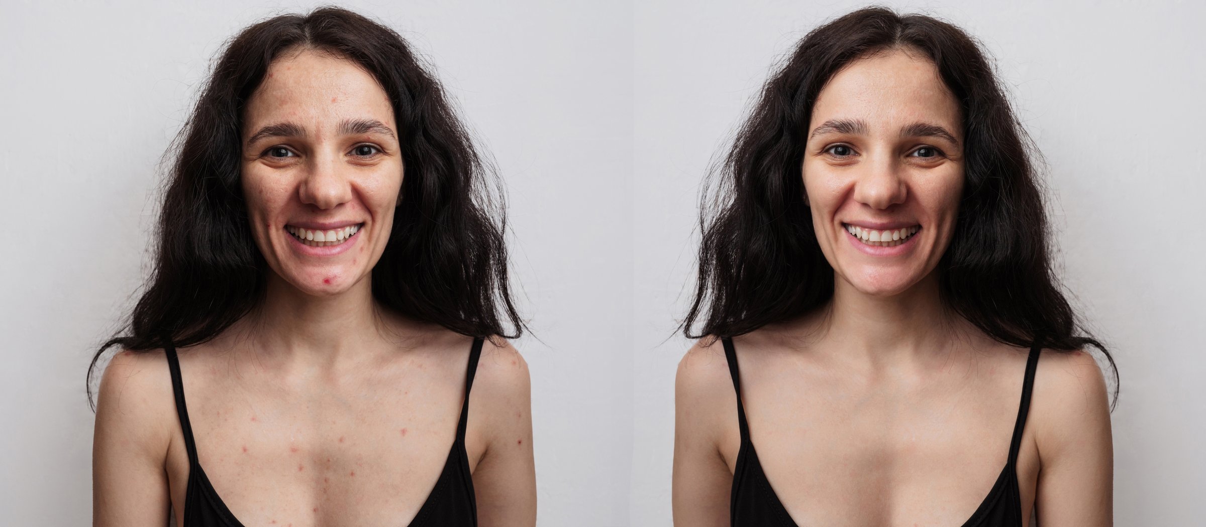 A young woman before and after acne treatment on a beige background.