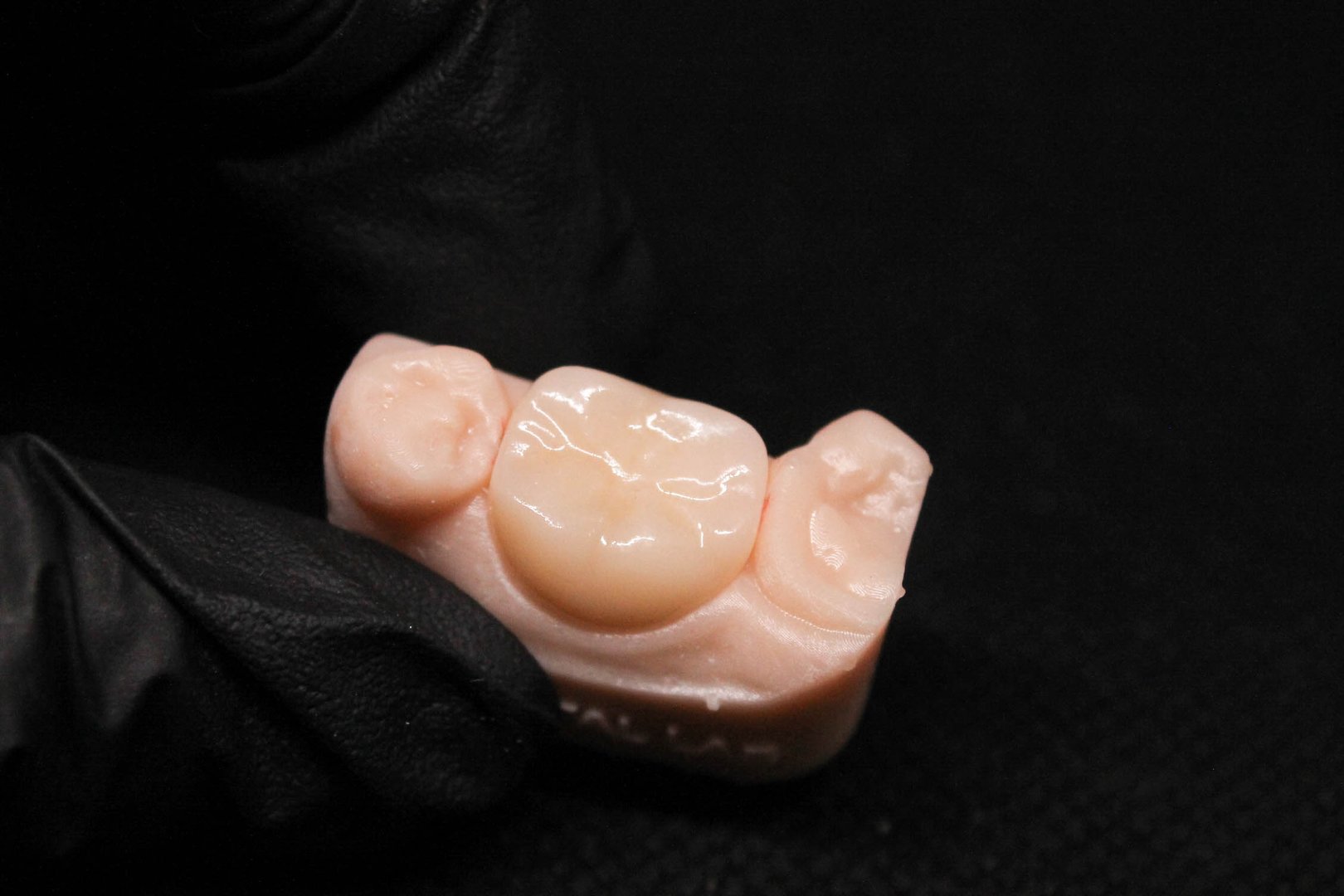 Corona dental unitaria