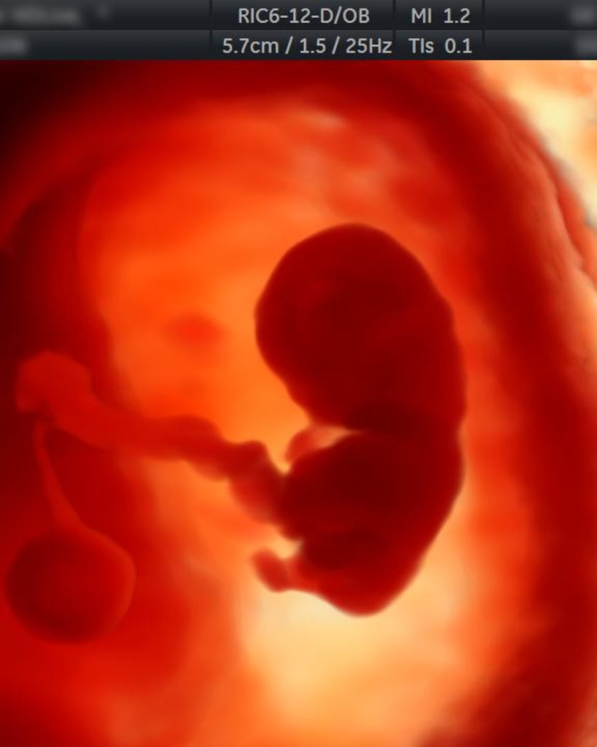 Control Prenatal Temprano